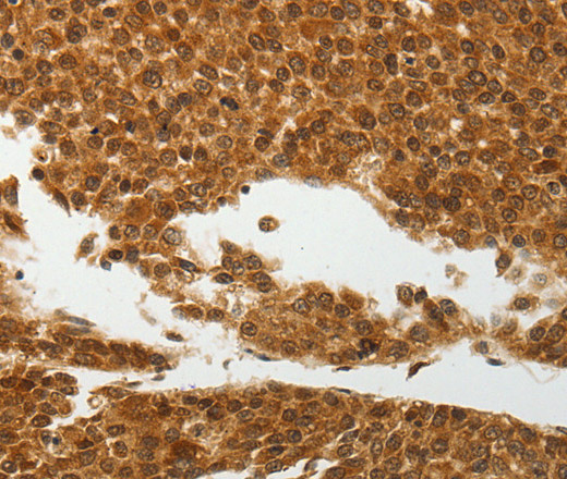 Immunohistochemistry of paraffin-embedded Human liver cancer tissue using SOCS7 Polyclonal Antibody at dilution 1:30