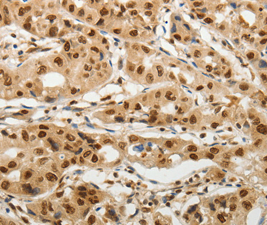 Immunohistochemistry of paraffin-embedded Human lung cancer tissue using SOCS7 Polyclonal Antibody at dilution 1:30