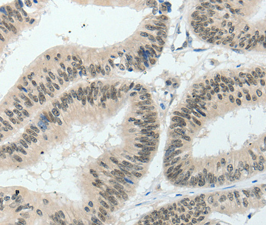 Immunohistochemistry of paraffin-embedded Human colon cancer tissue using HNF1B Polyclonal Antibody at dilution 1:80