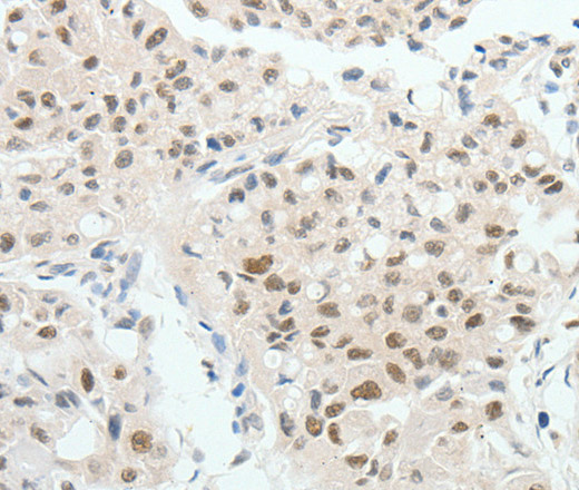 Immunohistochemistry of paraffin-embedded Human lung cancer tissue using HNF1B Polyclonal Antibody at dilution 1:80