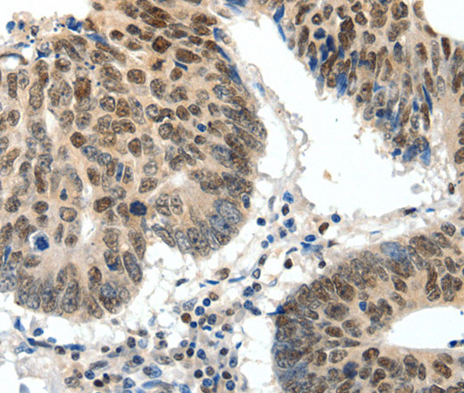 Immunohistochemistry of paraffin-embedded Human colon cancer tissue using TOP2A Polyclonal Antibody at dilution 1:30