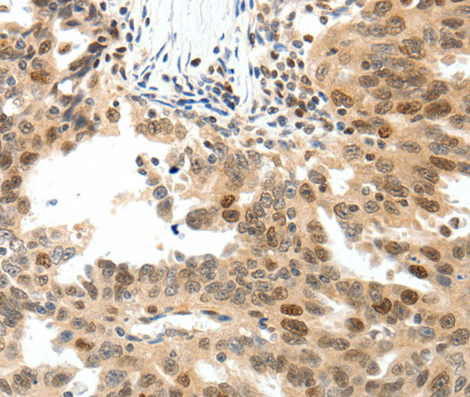 Immunohistochemistry of paraffin-embedded Human ovarian cancer tissue using TOP2A Polyclonal Antibody at dilution 1:30