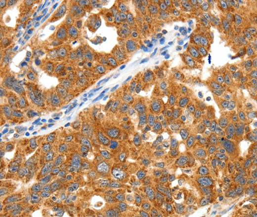 Immunohistochemistry of paraffin-embedded Human ovarian cancer using TRAF3 Polyclonal Antibody at dilution of 1:40