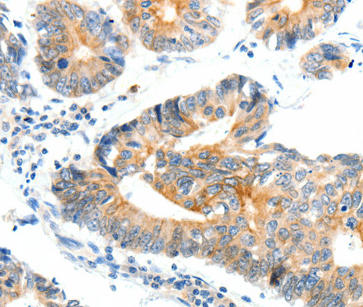 Immunohistochemistry of paraffin-embedded Human colon cancer tissue using NTRK1 Polyclonal Antibody at dilution 1:90