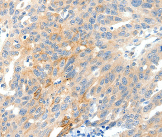 Immunohistochemistry of paraffin-embedded Human ovarian cancer tissue using NTRK1 Polyclonal Antibody at dilution 1:90