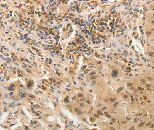 Immunohistochemistry of paraffin-embedded Human lung cancer tissue using ADAR Polyclonal Antibody at dilution 1:40