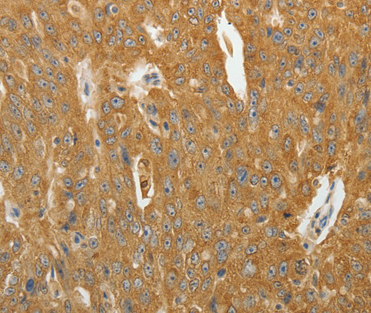 Immunohistochemistry of paraffin-embedded Human ovarian cancer using AKR1B1 Polyclonal Antibody at dilution of 1:40