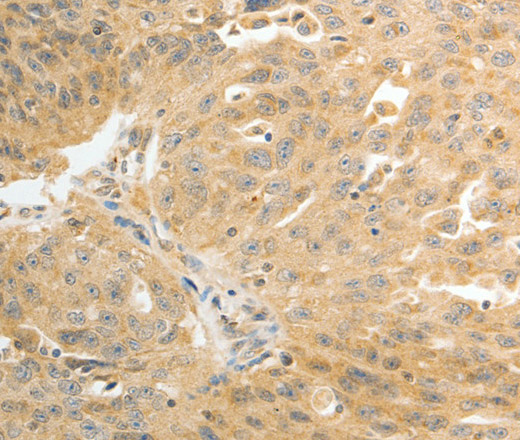 Immunohistochemistry of paraffin-embedded Human ovarian cancer using AKR1C1 Polyclonal Antibody at dilution of 1:30