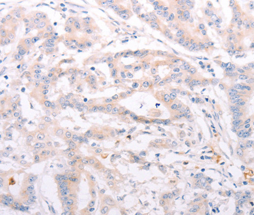 Immunohistochemistry of paraffin-embedded Human colon cancer tissue using ANKRA2 Polyclonal Antibody at dilution 1:50