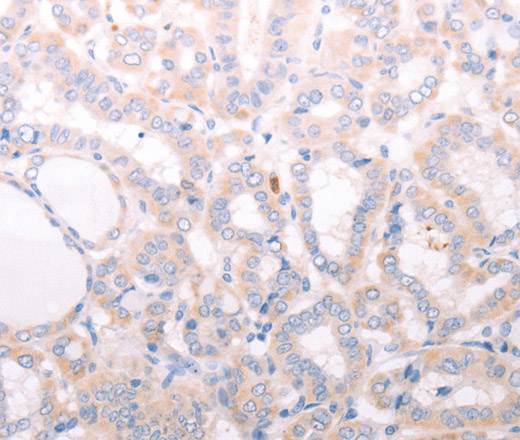 Immunohistochemistry of paraffin-embedded Human thyroid cancer tissue using ANKRA2 Polyclonal Antibody at dilution 1:50