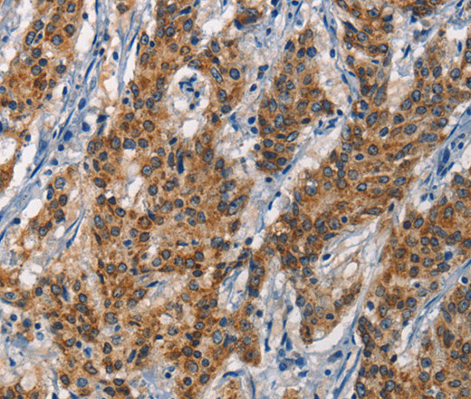 Immunohistochemistry of paraffin-embedded Human gastic cancer using APOL1 Polyclonal Antibody at dilution of 1:40