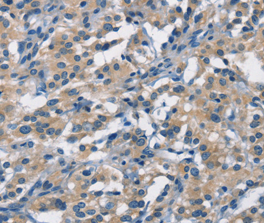 Immunohistochemistry of paraffin-embedded Human thyroid cancer using APOL1 Polyclonal Antibody at dilution of 1:40