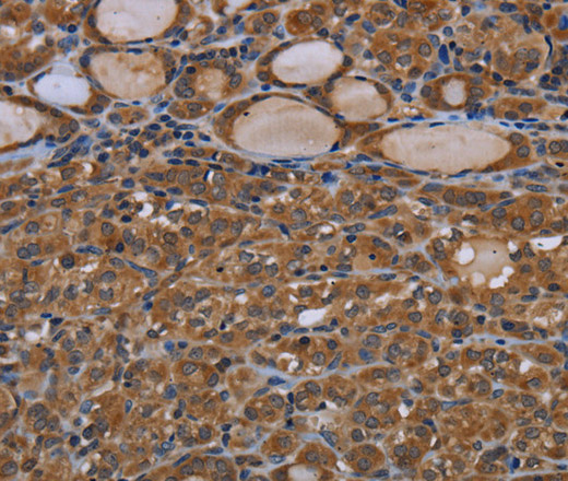 Immunohistochemistry of paraffin-embedded Human thyroid cancer using GJB4 Polyclonal Antibody at dilution of 1:40