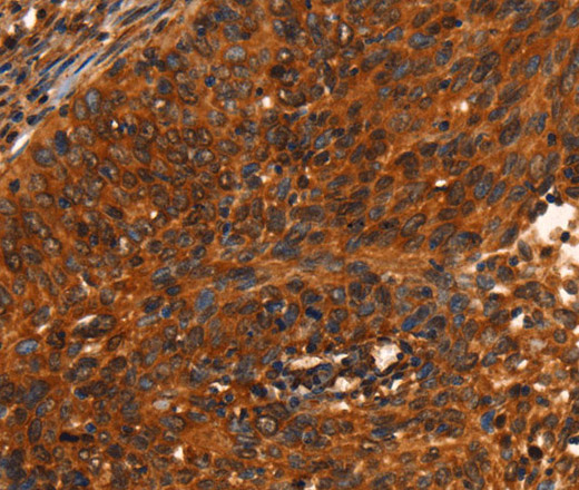 Immunohistochemistry of paraffin-embedded Human cervical cancer using PRKD1 Polyclonal Antibody at dilution of 1:40