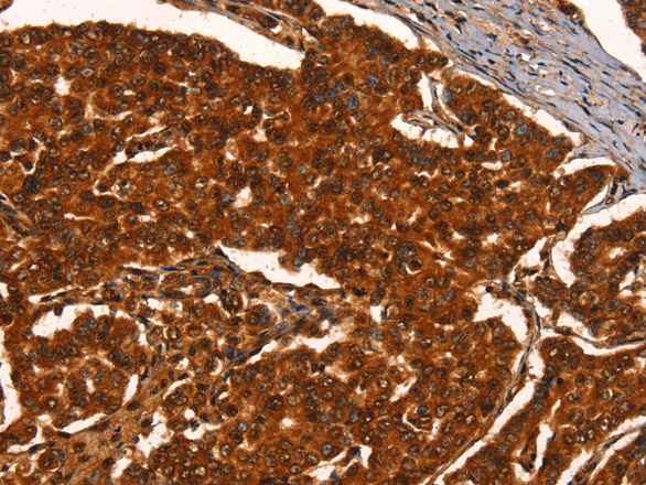 Immunohistochemistry of paraffin-embedded Human breast cancer using PRKD1 Polyclonal Antibody at dilution of 1:40