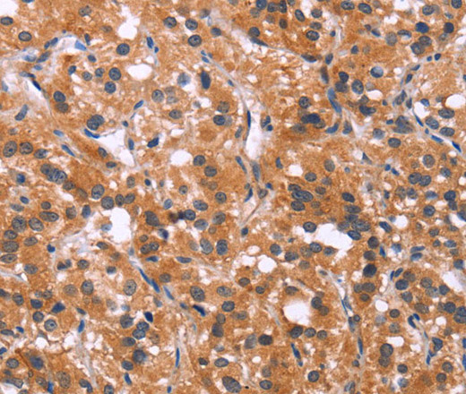 Immunohistochemistry of paraffin-embedded Human thyroid cancer using MAPK11  Polyclonal Antibody at dilution of 1:30