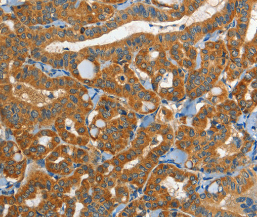 Immunohistochemistry of paraffin-embedded Human thyroid cancer tissue using EPHB3 Polyclonal Antibody at dilution 1:40