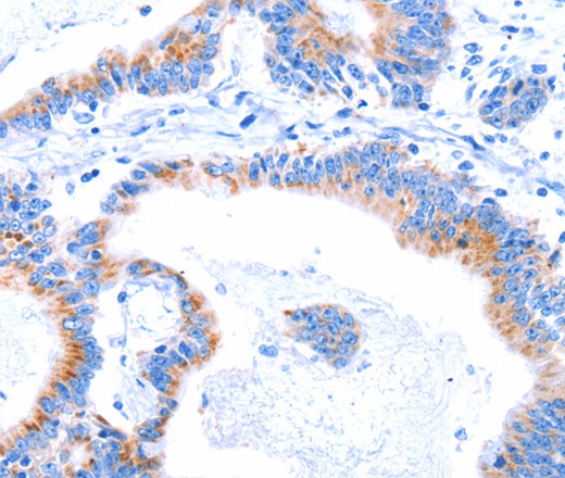 Immunohistochemistry of paraffin-embedded Human colon cancer tissue using SMG8 Polyclonal Antibody at dilution 1:50