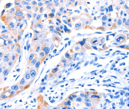 Immunohistochemistry of paraffin-embedded Human lung cancer tissue using SMG8 Polyclonal Antibody at dilution 1:50