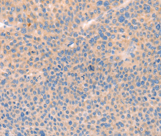 Immunohistochemistry of paraffin-embedded Human liver cancer tissue using CD109 Polyclonal Antibody at dilution 1:30