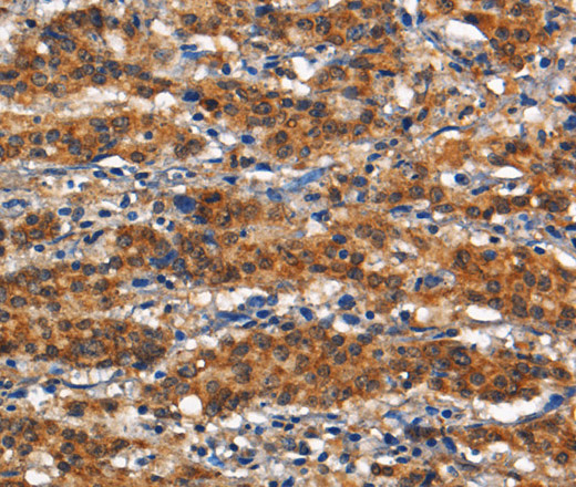 Immunohistochemistry of paraffin-embedded Human gasrtic cancer tissue using CD13 Polyclonal Antibody at dilution 1:80