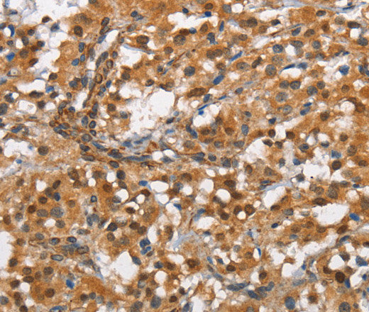 Immunohistochemistry of paraffin-embedded Human thyroid cancer tissue using CD13 Polyclonal Antibody at dilution 1:80