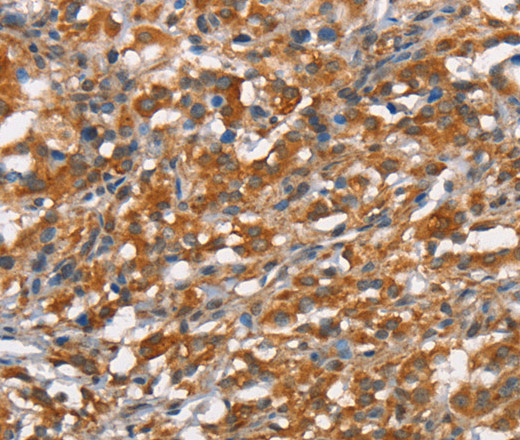Immunohistochemistry of paraffin-embedded Human thyroid cancer tissue using CD168 Polyclonal Antibody at dilution 1:40