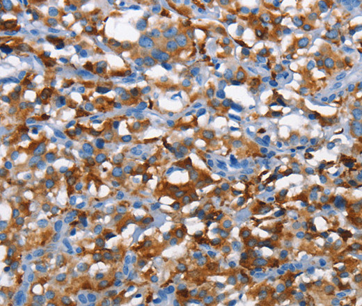 Immunohistochemistry of paraffin-embedded Human thyroid cancer tissue using CD226 Polyclonal Antibody at dilution 1:60