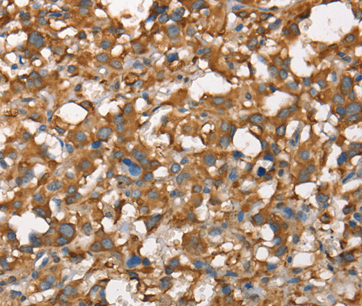 Immunohistochemistry of paraffin-embedded Human thyroid cancer tissue using CDC25A Polyclonal Antibody at dilution 1:60