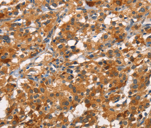 Immunohistochemistry of paraffin-embedded Human thyroid cancer tissue using CDC25B  Polyclonal Antibody at dilution 1:45