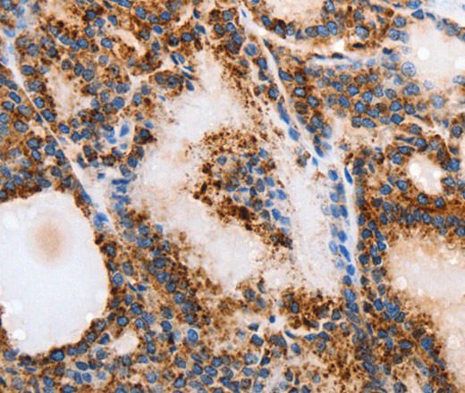 Immunohistochemistry of paraffin-embedded Human thyroid cancer tissue using MUC6 Polyclonal Antibody at dilution 1:40