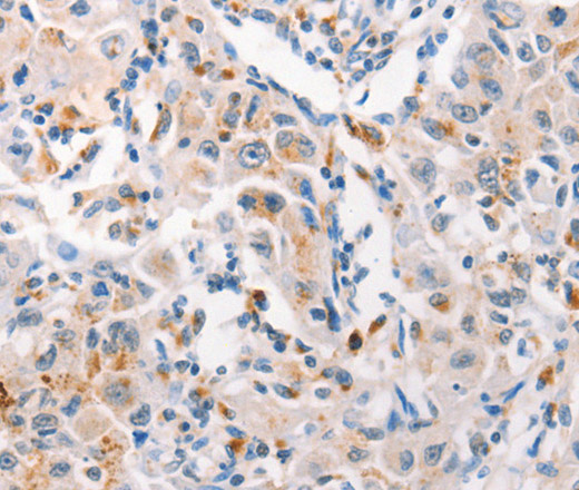 Immunohistochemistry of paraffin-embedded Human liver cancer tissue using MUC2 Polyclonal Antibody at dilution 1:60