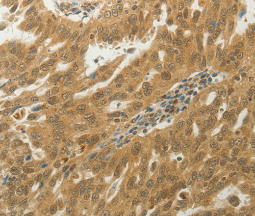 Immunohistochemistry of paraffin-embedded Human ovarian cancer tissue using MYSM1 Polyclonal Antibody at dilution 1:50