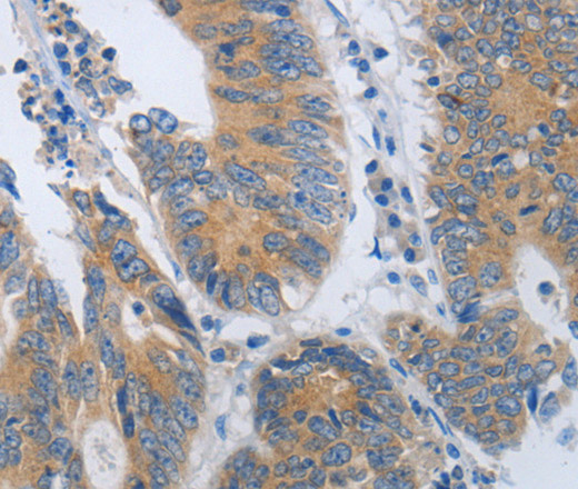 Immunohistochemistry of paraffin-embedded Human colon cancer using CD10 Polyclonal Antibody at dilution of 1:45