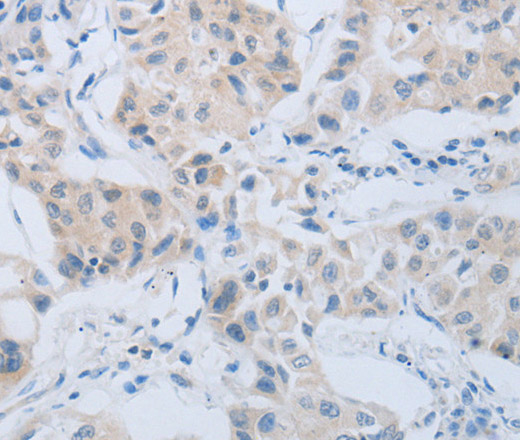 Immunohistochemistry of paraffin-embedded Human lung cancer using CD10 Polyclonal Antibody at dilution of 1:45