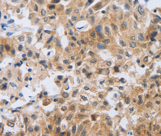 Immunohistochemistry of paraffin-embedded Human lung cancer tissue using NEB Polyclonal Antibody at dilution 1:80