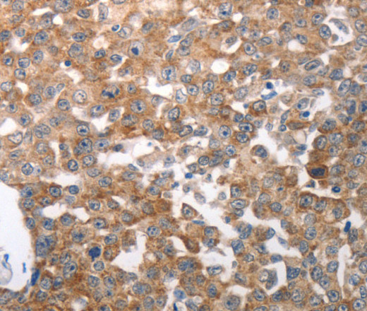 Immunohistochemistry of paraffin-embedded Human breast cancer using NQO2 Polyclonal Antibody at dilution of 1:50