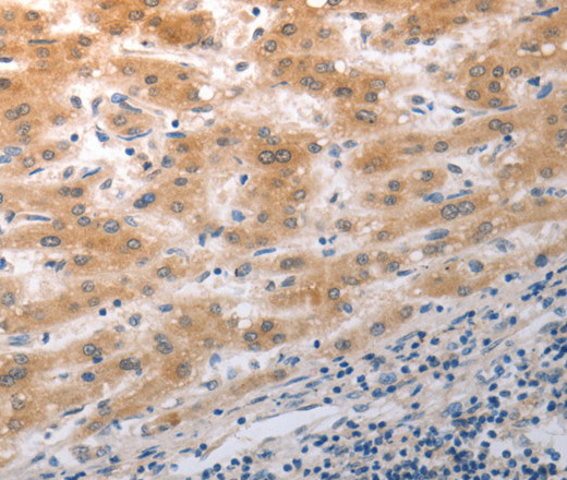 Immunohistochemistry of paraffin-embedded Human liver cancer using NQO2 Polyclonal Antibody at dilution of 1:50