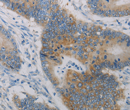 Immunohistochemistry of paraffin-embedded Human colon cancer tissue using CD303 Polyclonal Antibody at dilution of 1:50