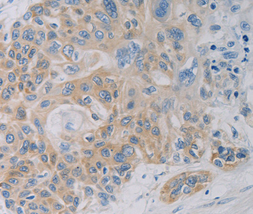 Immunohistochemistry of paraffin-embedded Human esophagus cancer using CD303 Polyclonal Antibody at dilution of 1:50