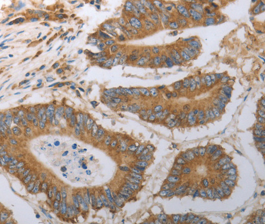 Immunohistochemistry of paraffin-embedded Human colon cancer using SLC22A6 Polyclonal Antibody at dilution of 1:40