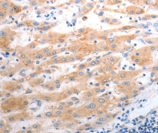 Immunohistochemistry of paraffin-embedded Human liver cancer using SLC22A6 Polyclonal Antibody at dilution of 1:40