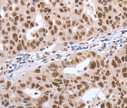 Immunohistochemistry of paraffin-embedded Human ovarian cancer tissue using Oct-6 Polyclonal Antibody at dilution 1:40