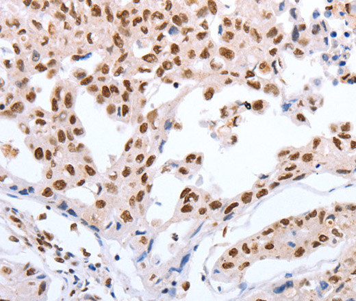 Immunohistochemistry of paraffin-embedded Human lung cancer tissue using Oct-6 Polyclonal Antibody at dilution 1:40