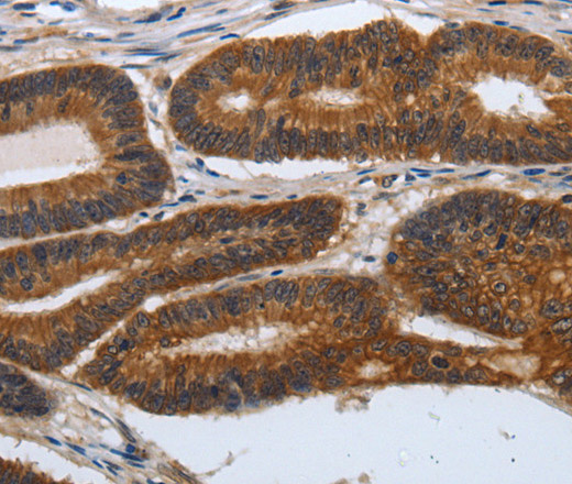 Immunohistochemistry of paraffin-embedded Human colon cancer tissue using PDCD7 Polyclonal Antibody at dilution 1:60