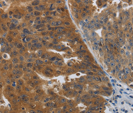 Immunohistochemistry of paraffin-embedded Human ovarian cancer tissue using PDCD2 Polyclonal Antibody at dilution 1:50