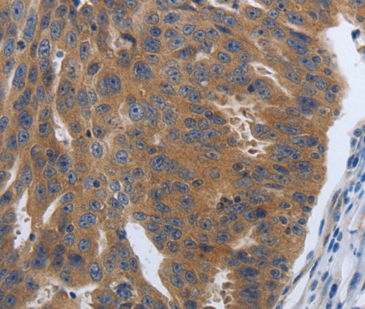 Immunohistochemistry of paraffin-embedded Human ovarian cancer tissue using PDGFA Polyclonal Antibody at dilution 1:70