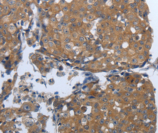 Immunohistochemistry of paraffin-embedded Human breast cancer tissue using PDIA2 Polyclonal Antibody at dilution 1:50