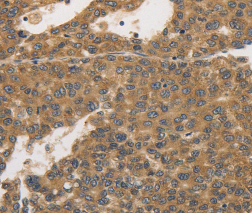 Immunohistochemistry of paraffin-embedded Human liver cancer tissue using PRKD1 Polyclonal Antibody at dilution 1:30