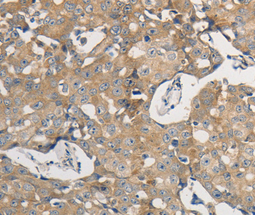 Immunohistochemistry of paraffin-embedded Human breast cancer using PPP2CB Polyclonal Antibody at dilution of 1:50